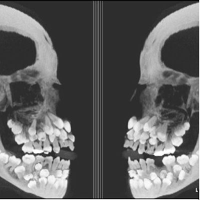 xray of baby teeth